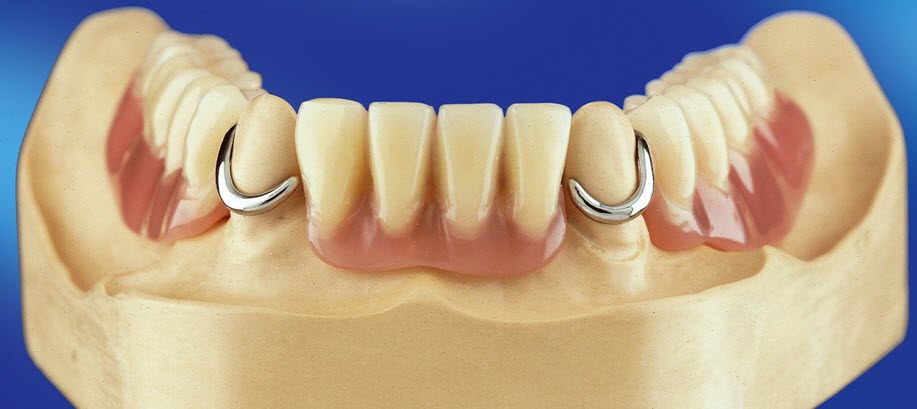 bugelniy-protez-v-orshe