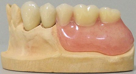 bugelniy-protez-v-orshe